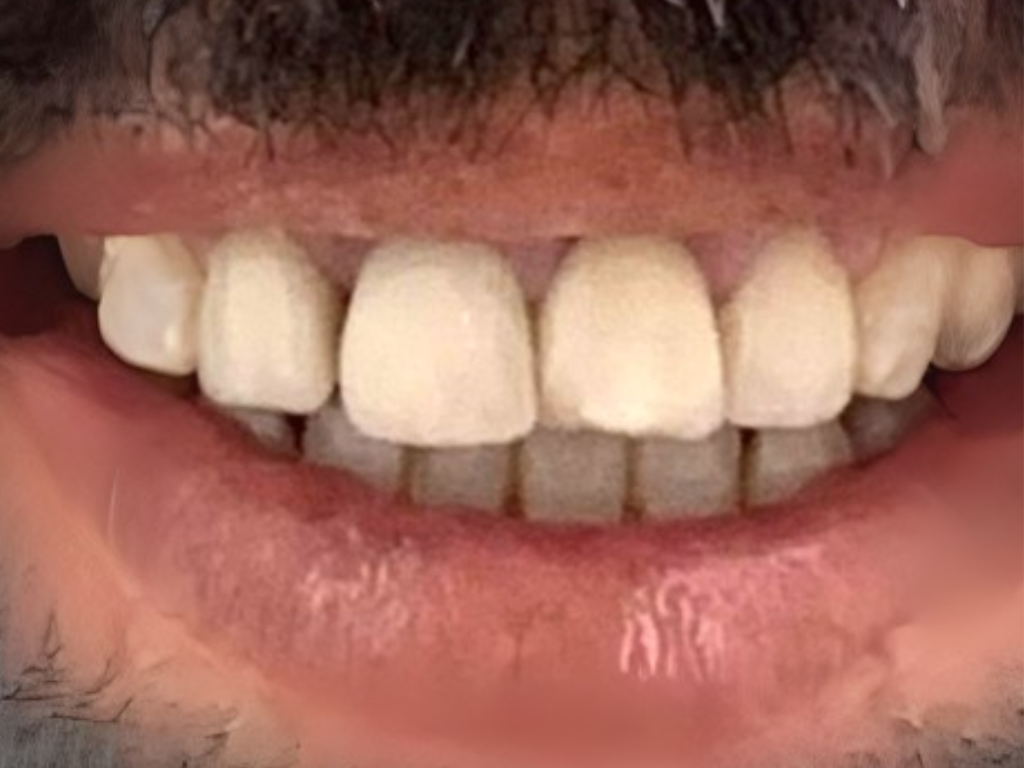 Antes - Dientes con pigmentación profunda y forma irregular