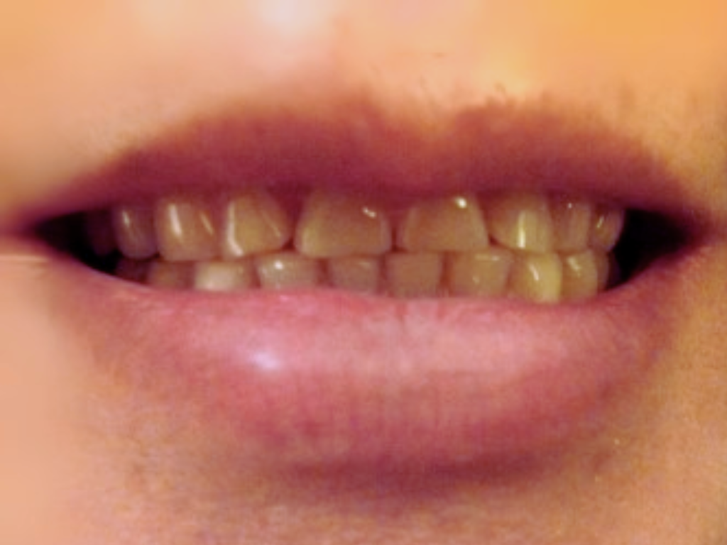 Antes - Dientes cortos, desiguales y descoloridos