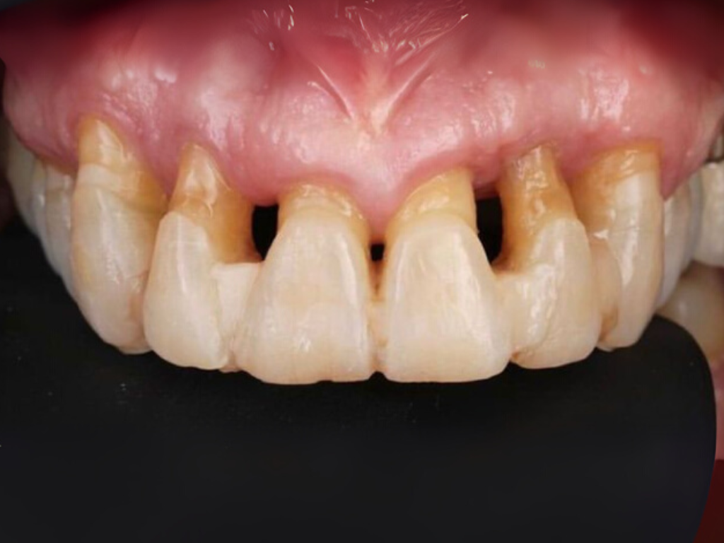 Antes - Implantes Dentales