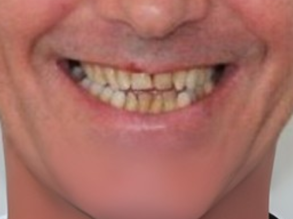 Antes - Rehabilitación Oral Completa con Prótesis Fijas