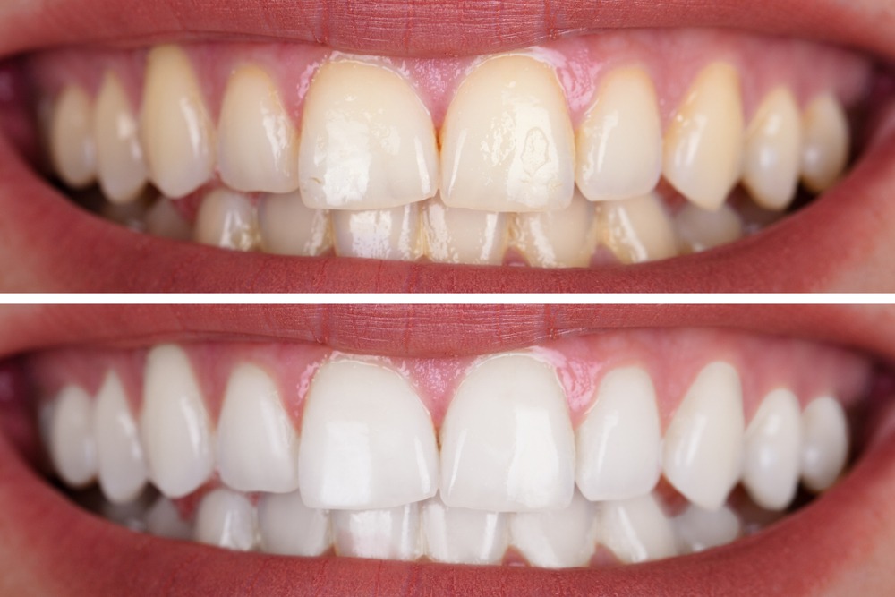 Blanqueamiento Dental - Dental Plus Cancún
