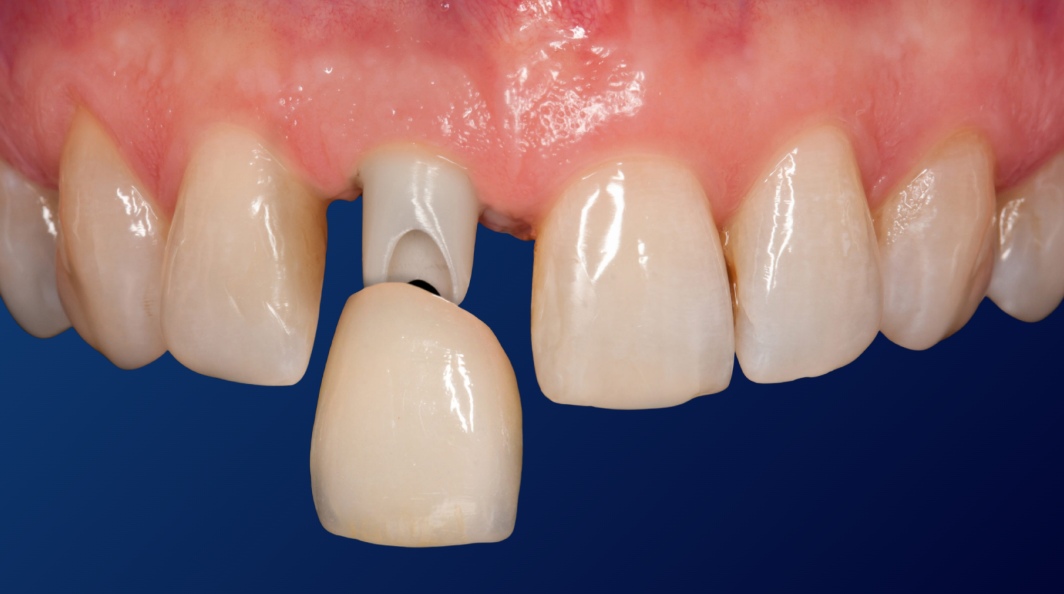 Coronas Dentales - Dental Plus Cancún