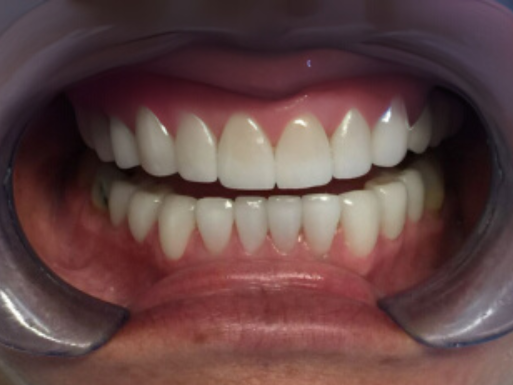 Después - Sonrisa renovada con carillas y blanqueamiento