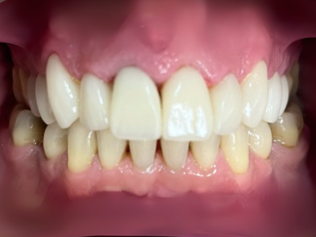 Después - Sonrisa perfectamente alineada con ortodoncia invisible