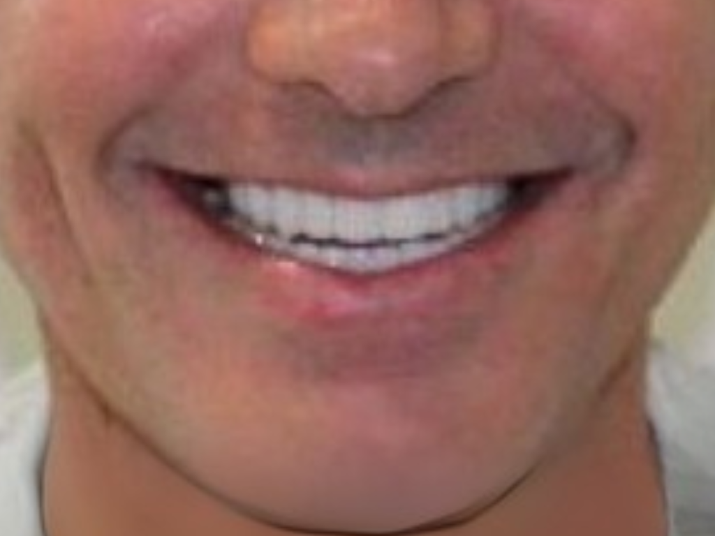 Después - Rehabilitación Oral Completa con Prótesis Fijas