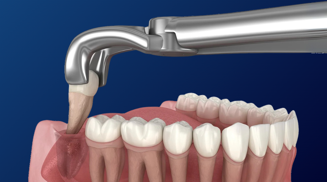 Extracciones - Dental Plus Cancún
