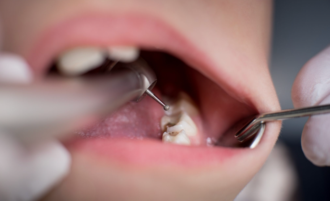 Obturaciones - Dental Plus Cancún