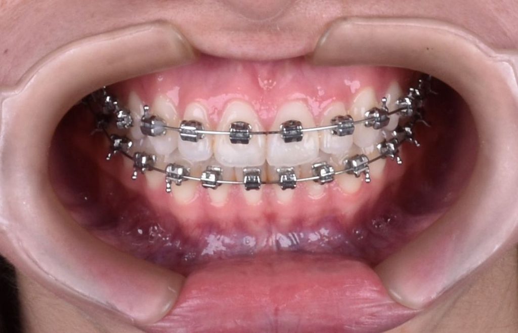 Ortodoncia - Dental Plus Cancún